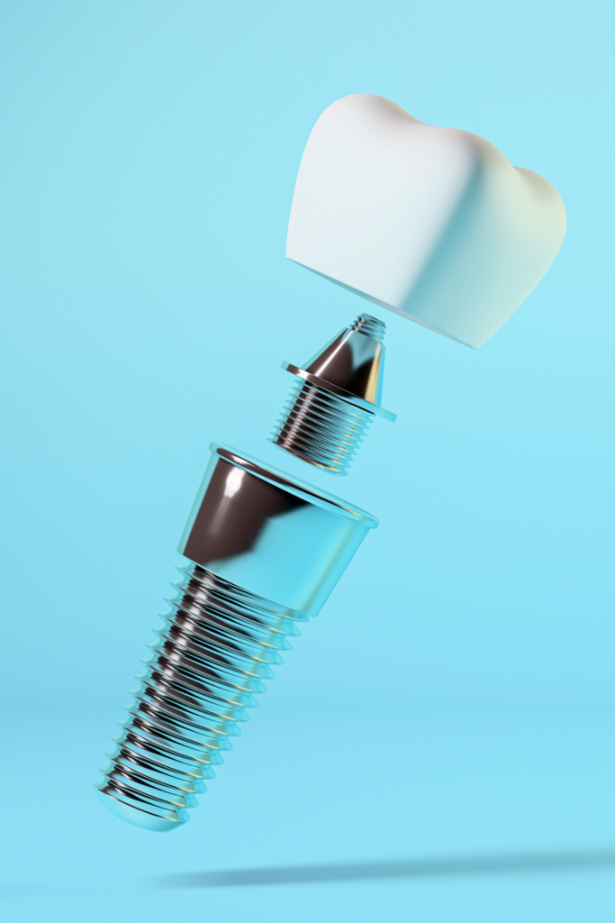 dental implant services at crown dental oman, in muscat