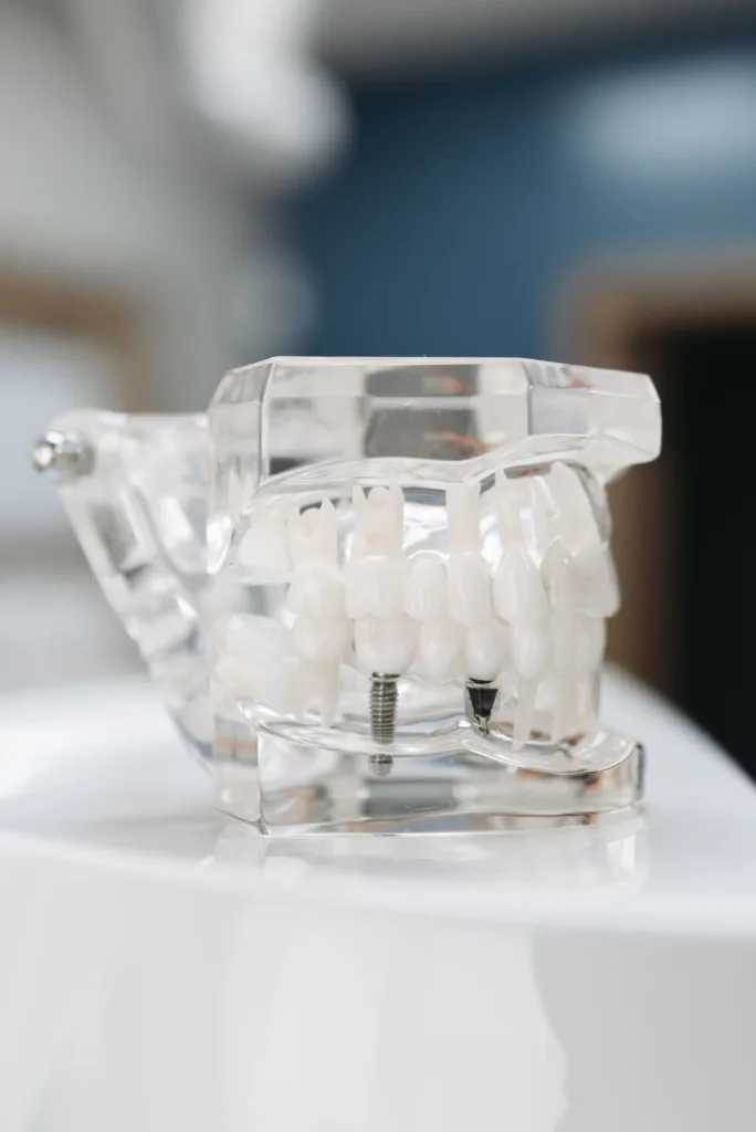 dental implant cost in Muscat Oman
